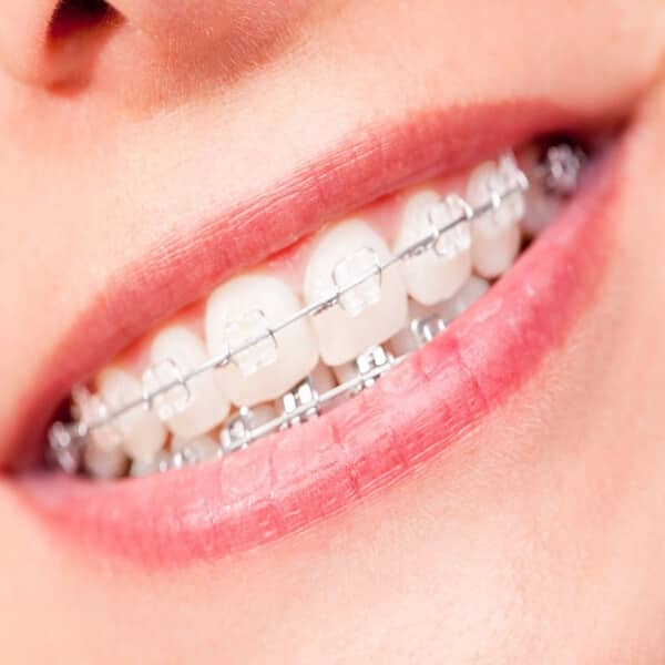 تقويم-الاسنان-الخزفي