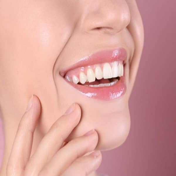 عمر تلبيسات الاسنان