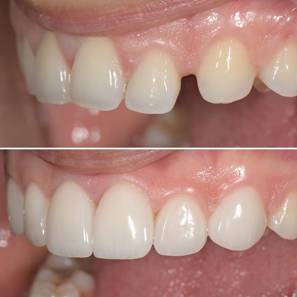 الفرق بين حشوات الاسنان التجميلية والعادية