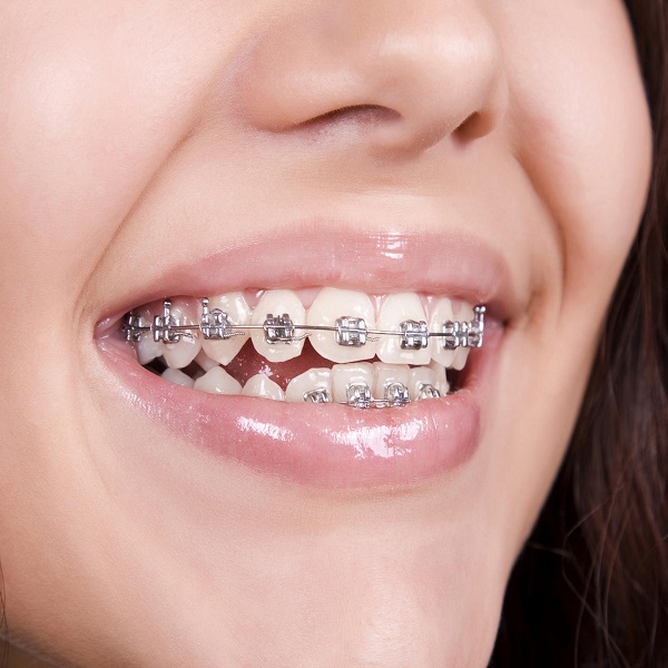 شروط تركيب تقويم الاسنان