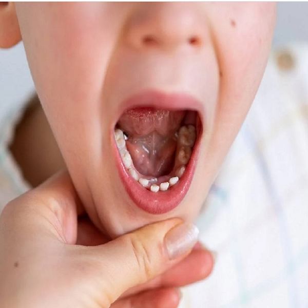 التهاب اللثة عند الاطفال